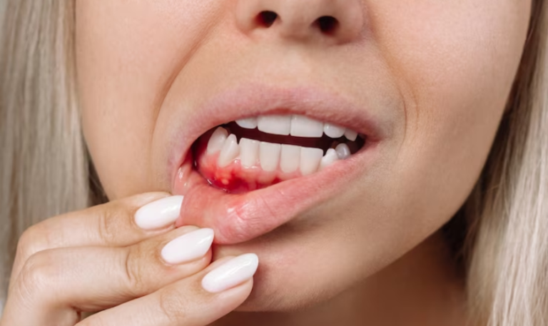 Warning signs of bleeding gums and gingivitis